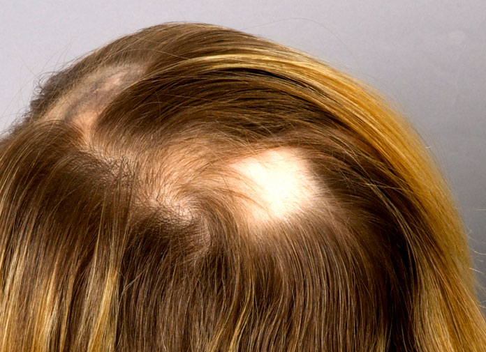 ¿Sabes qué es una Alopecia Areata? 1 Dra María José Álvarez - Tratamientos capilares, nutrición, corporal y facial en Pamplona
